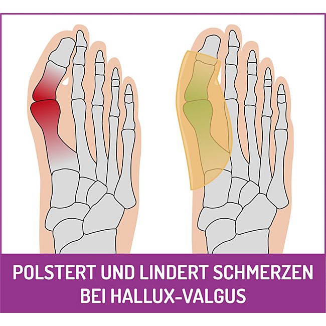 babybutt FußGut Hallux Überbeinschutz 1 Paar Günstiger Verkauf
